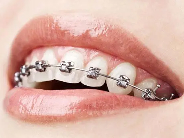 The role of orthodontic braces