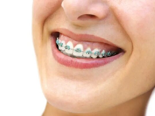 How long do I have to wear braces? 