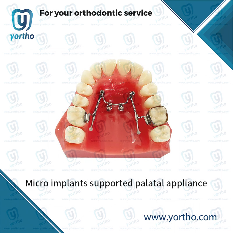 Niti spring for MISPA